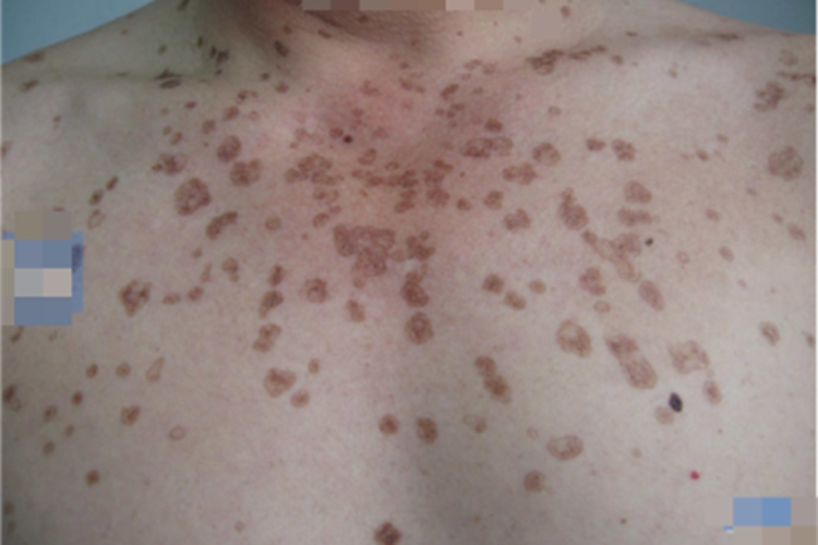 汗孔角化病长斑图 汗孔角化病长斑图