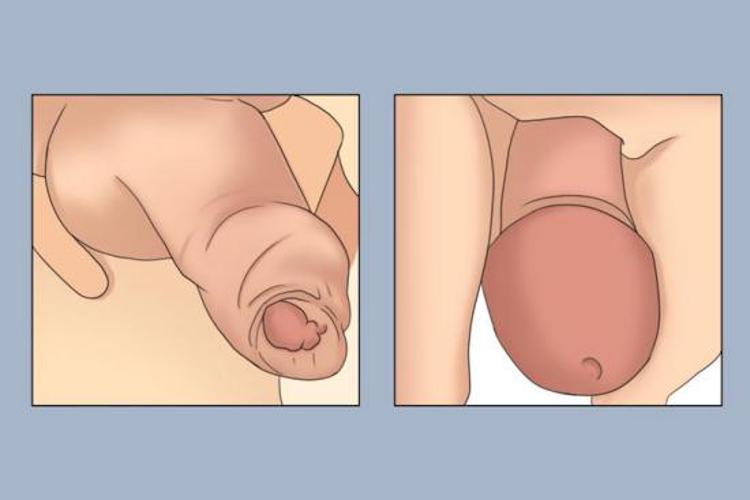 异常包皮和正常包皮图