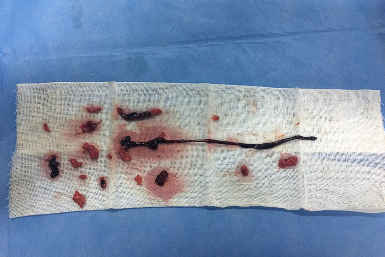 血管内混合血栓图 血管内混合血栓图