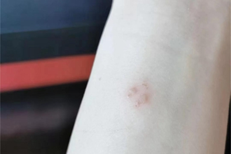 虫咬皮炎胳膊小水疱图 虫咬皮炎胳膊小水疱图