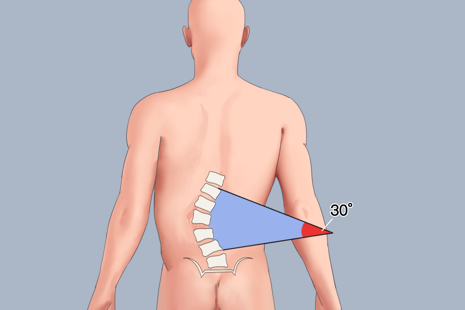 脊柱侧弯30度图
