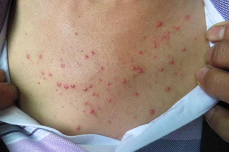 毛囊性脓疱病脓包图