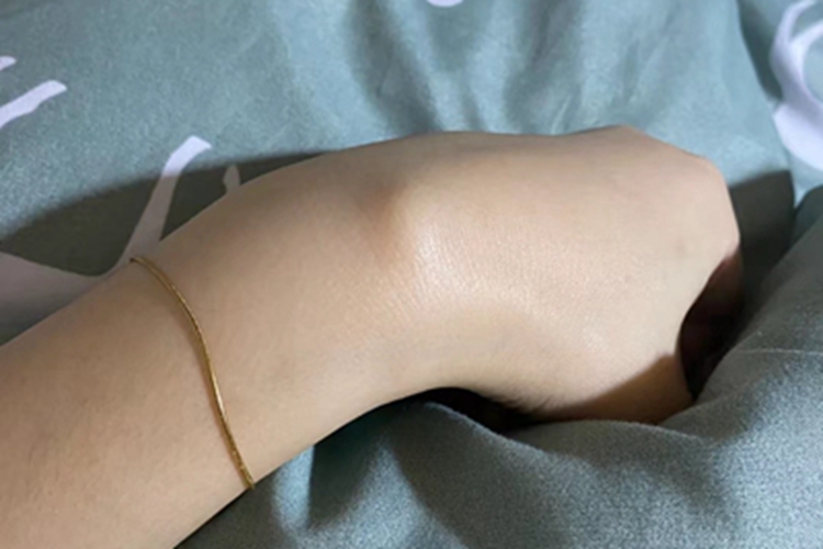 腱鞘纤维瘤手背大包图