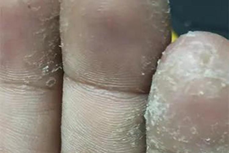 干性湿疹手部脱屑图