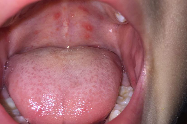 咽峡部的灰白色疱疹图