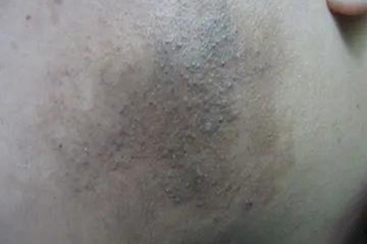 泛发型表皮痣面部症状图