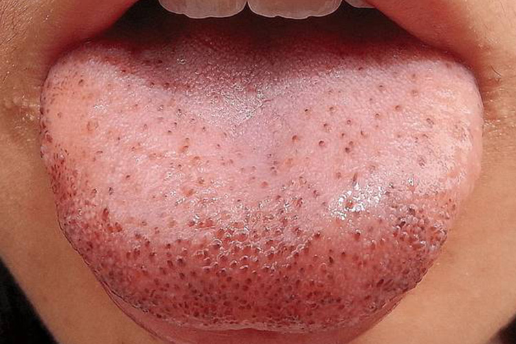 口腔黏膜淤点图