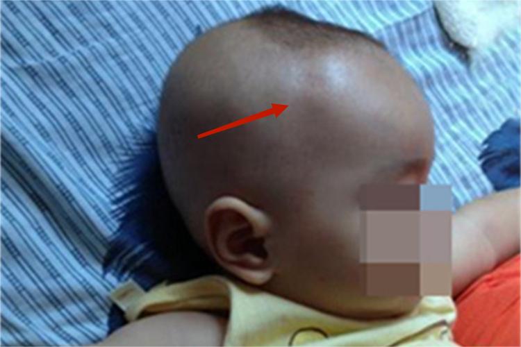 新生儿佝偻病症状图 新生儿佝偻病症状图