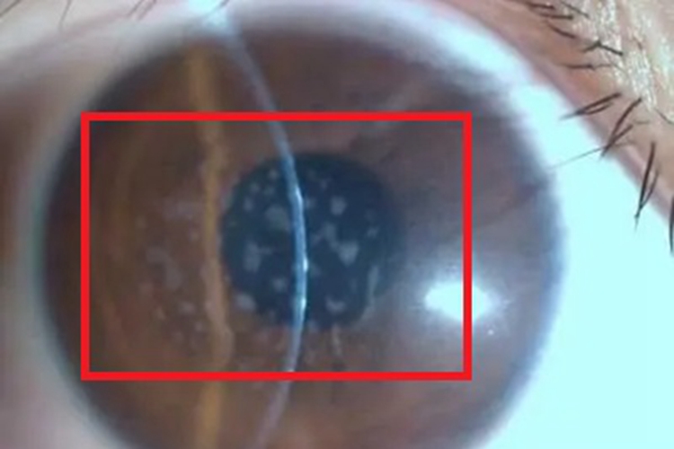 神经营养性角膜炎角膜症状图 神经营养性角膜炎角膜症状图