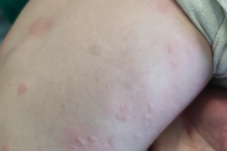 儿童大小不等红色风团图