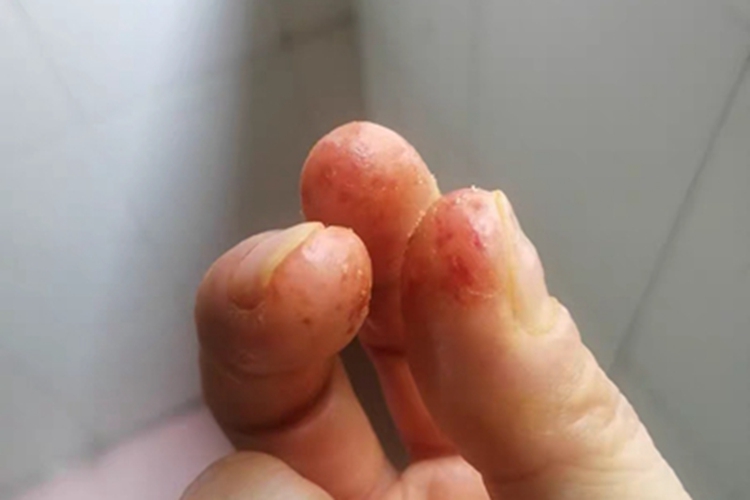 汗疱疹手指尖起小水疱图