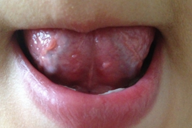 舌部感染HPV丘疹图 舌部感染HPV丘疹图