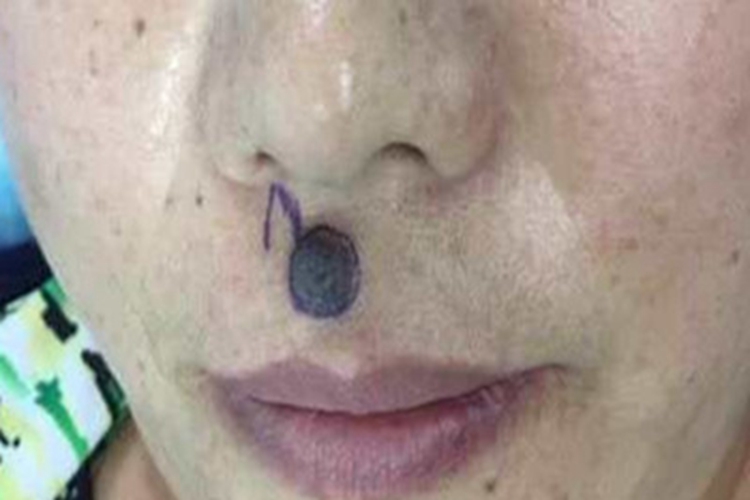 皮内痣鼻唇沟症状图