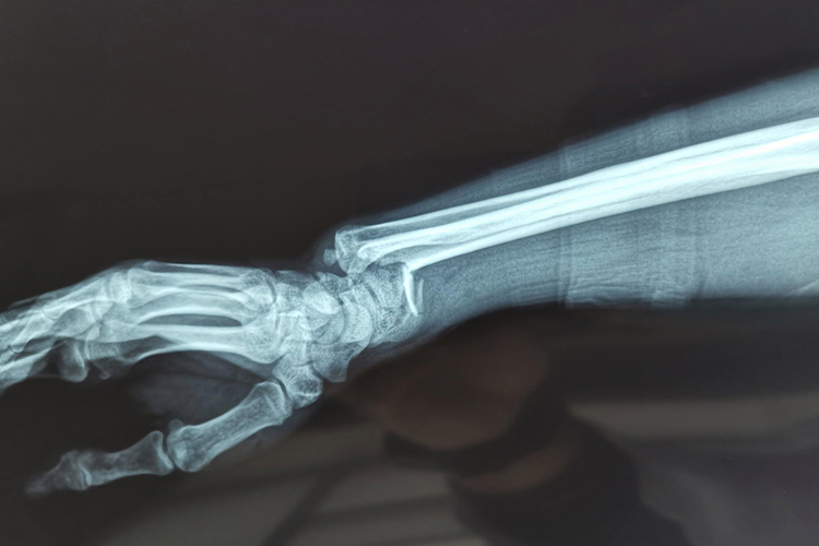 银叉样畸形X线图