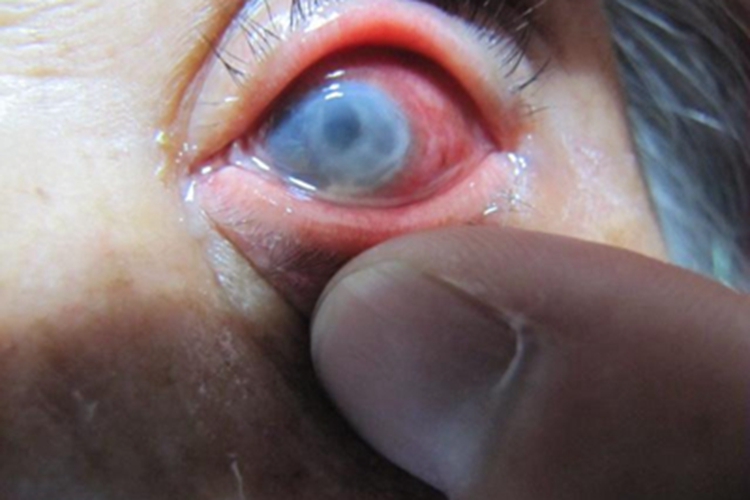 棘阿米巴角膜炎眼睛有白斑图