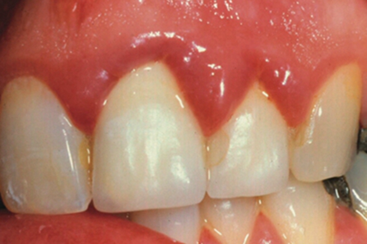 牙龈炎牙龈红肿且有萎缩图