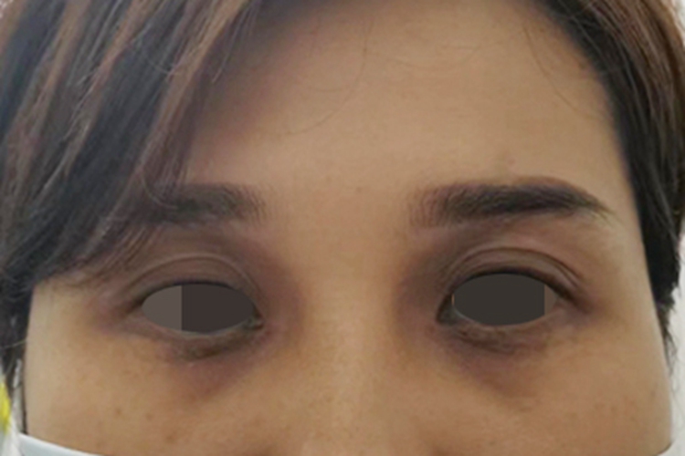 眶周色素沉着症眼睛周围发黑图