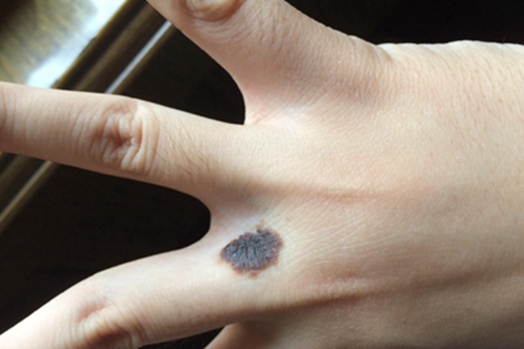 皮内痣手部黑斑图