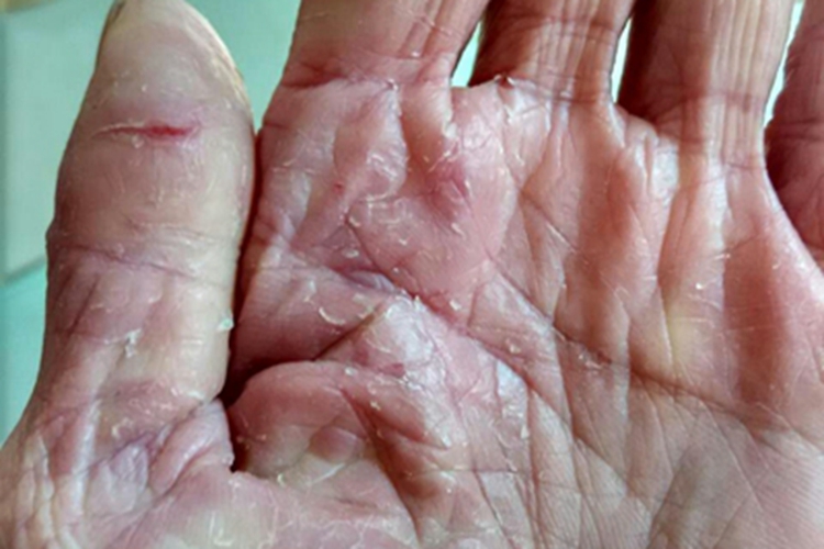 更年期角皮症裂口图