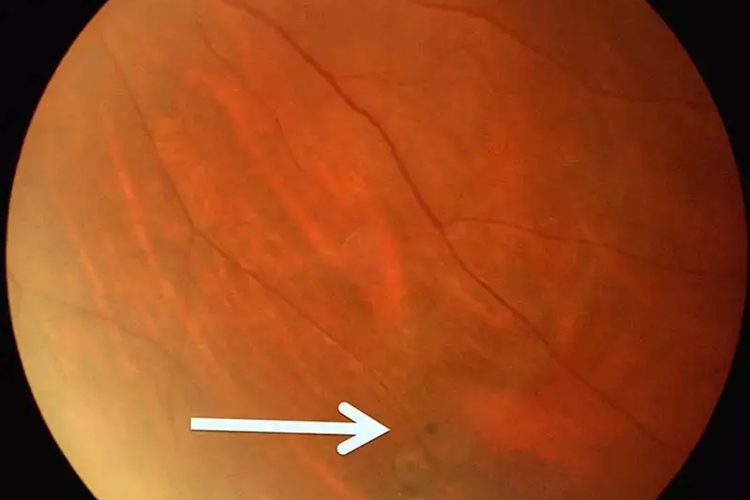 孔源性视网膜脱离图