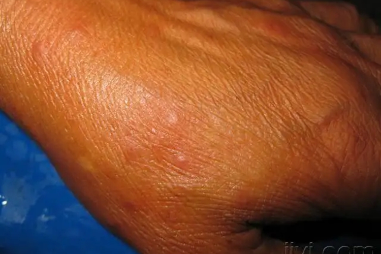 血吸虫尾蚴皮炎手背症状图