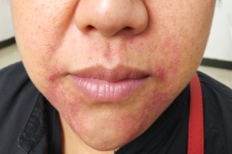 血管内压力增多性紫癜面部症状图