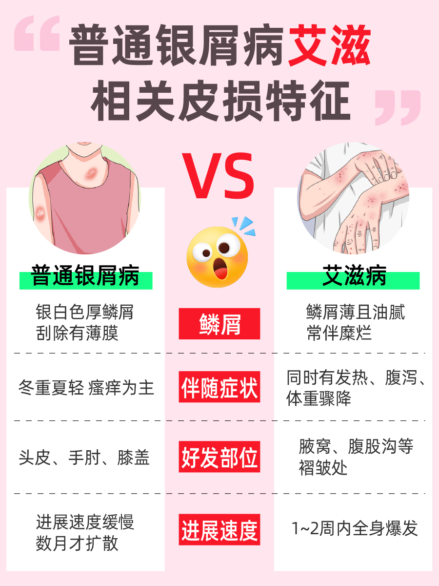 银屑病=艾滋病前兆?在线拆穿3大误区!