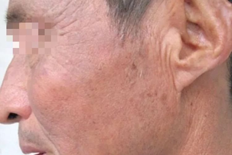 皮肤黑变病左脸发红发灰图 皮肤黑变病左脸发红发灰图