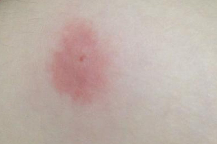 黄蚂蚁咬人瘀斑图 黄蚂蚁咬人瘀斑图