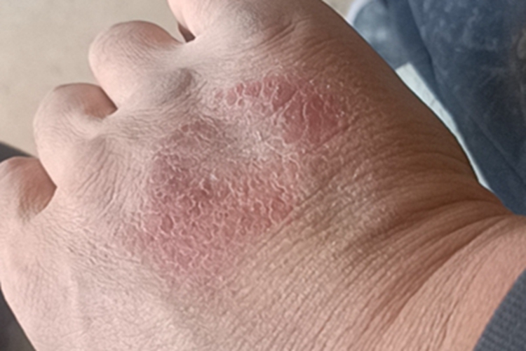 慢性湿疹手背红斑图