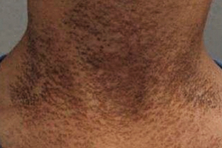 皮肤垢着病颈部丘疹图