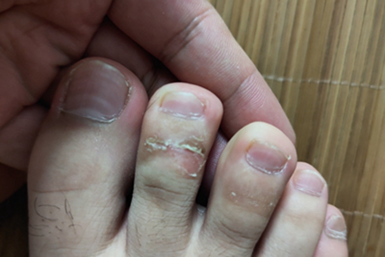 鳞屑角化型足癣脱皮图 鳞屑角化型足癣脱皮图