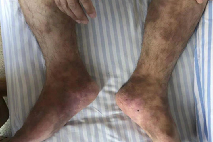 慢性期硬化性脂膜炎结节图