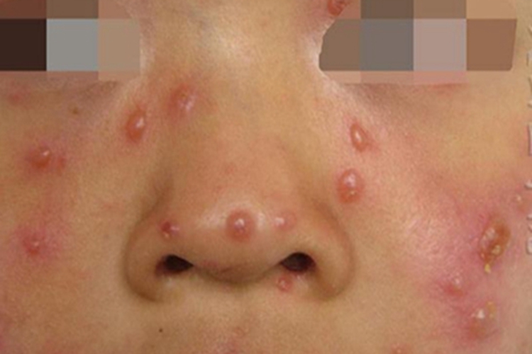 水痘脸上有很多水疱图