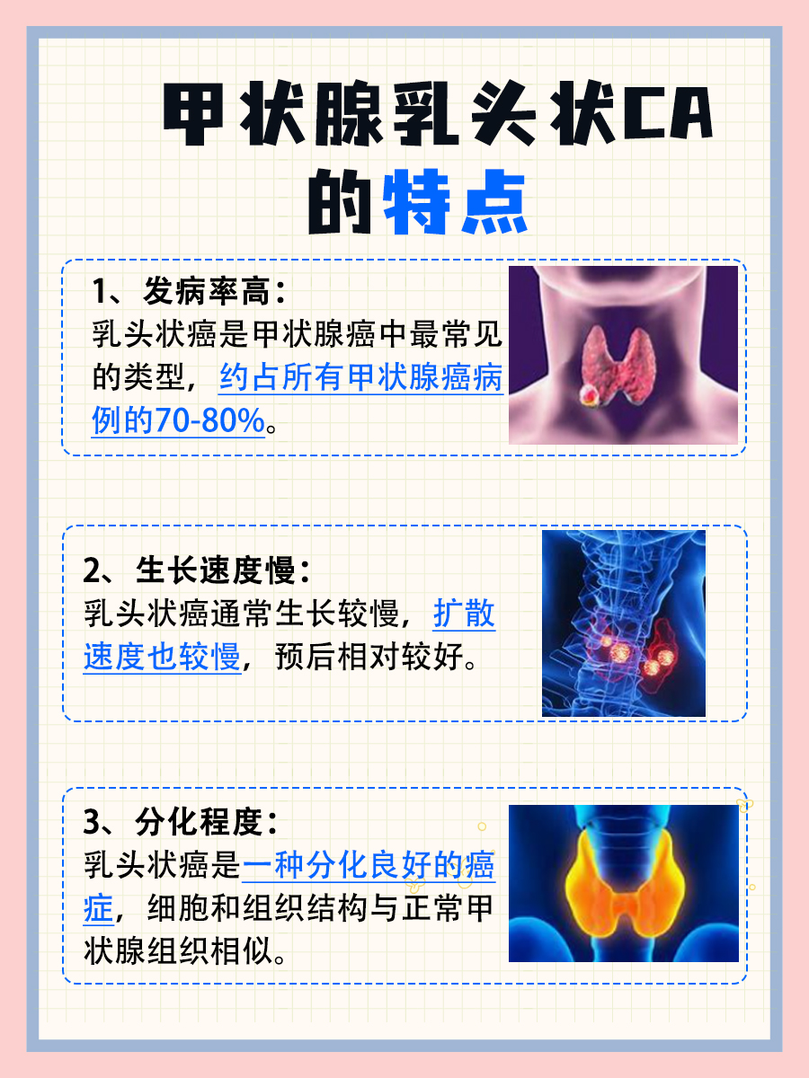 甲状腺乳头状CA是什么？带你认识这种疾病