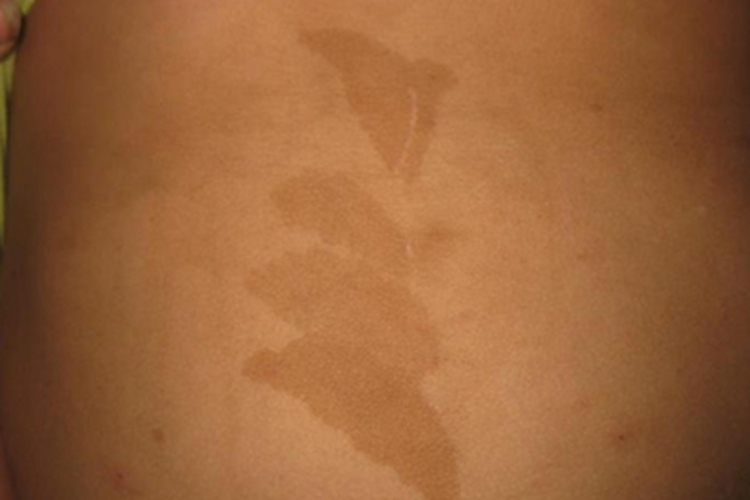 咖啡斑腹部长斑图