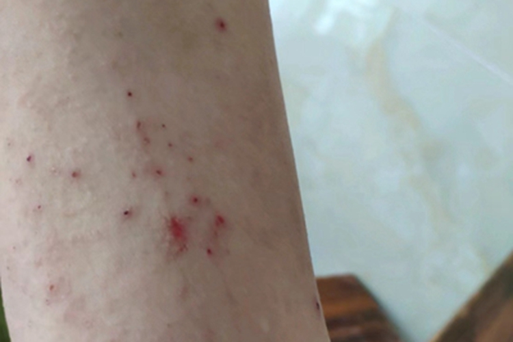 亚急性湿疹胳膊小疙瘩图