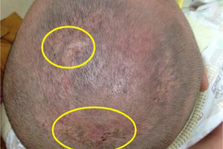 头癣头皮瘢痕图 头癣头皮瘢痕图