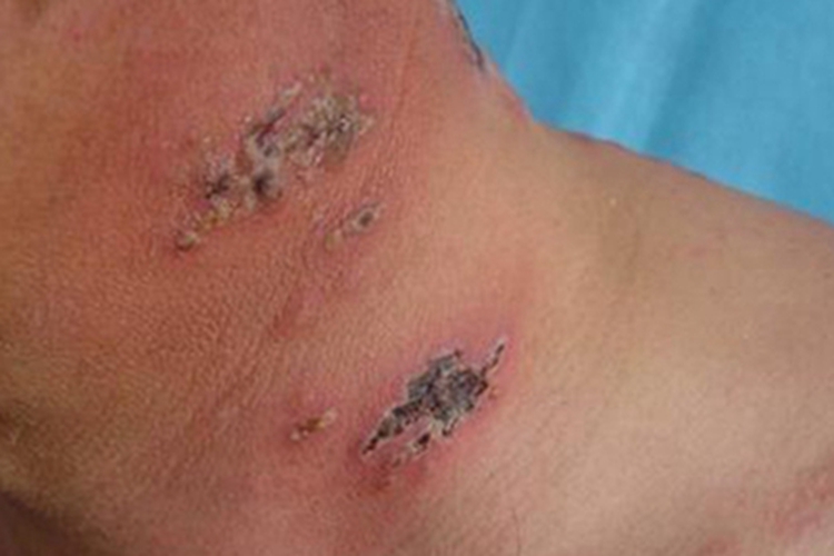 单纯疱疹颈部结痂图