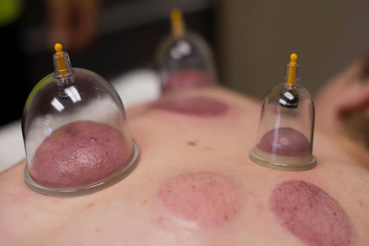 拔罐后罐印青紫色图