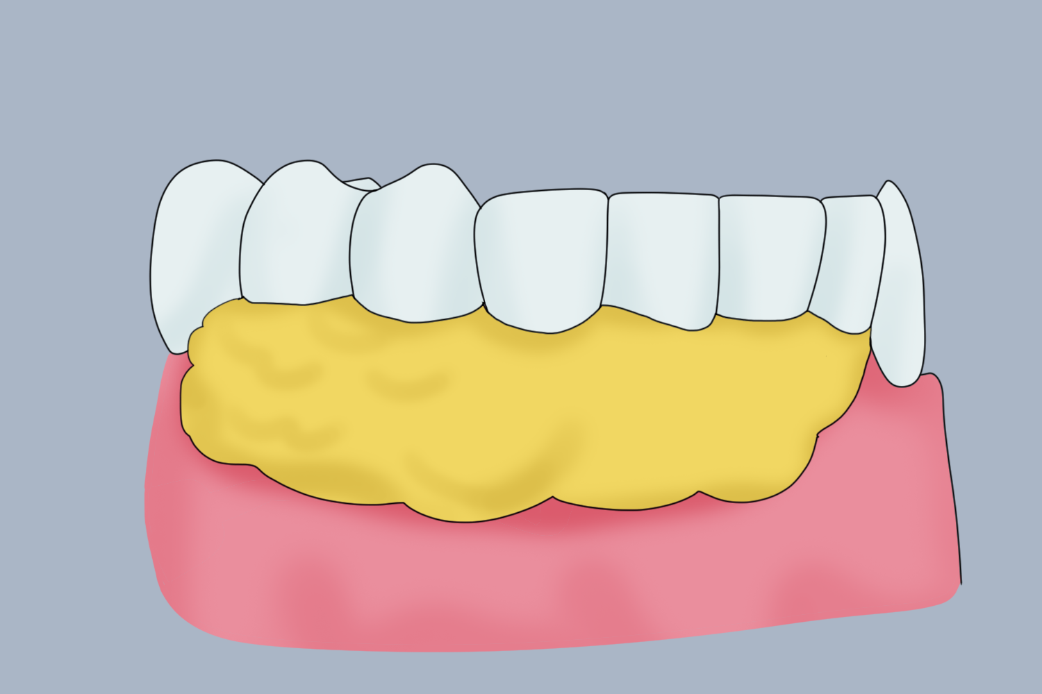 清洗创面并止血