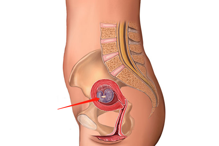 怀孕早期的子宫图 怀孕早期的子宫图