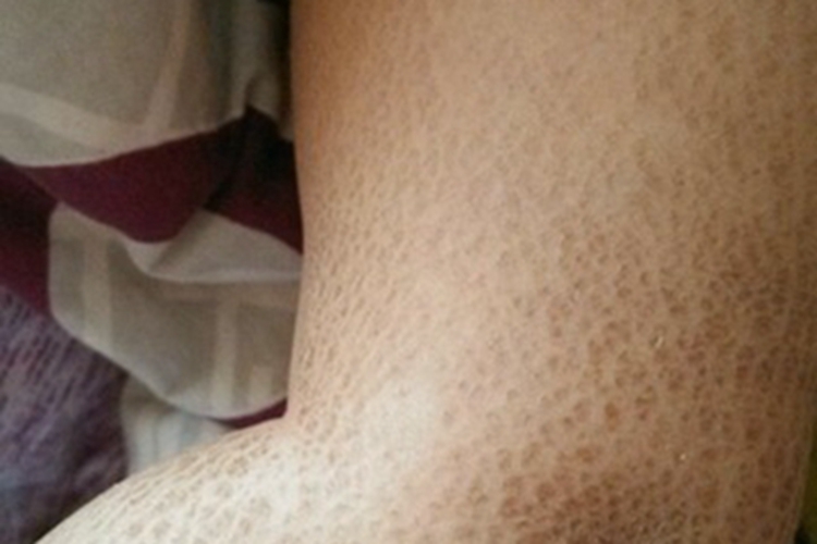 毛囊性鱼鳞病大腿斑图 毛囊性鱼鳞病大腿斑图