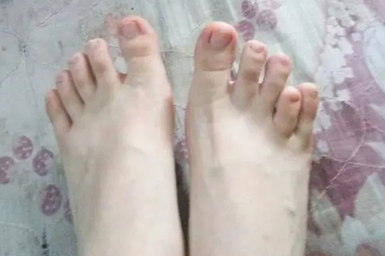 第四脚趾短小症图