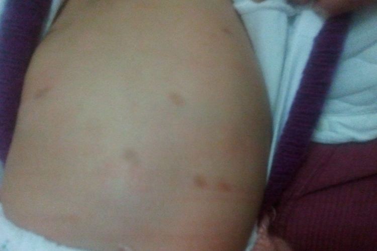 孩子花斑糠疹图