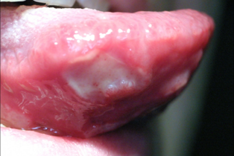 口腔黏膜结核性溃疡舌侧症状图 口腔黏膜结核性溃疡舌侧症状图