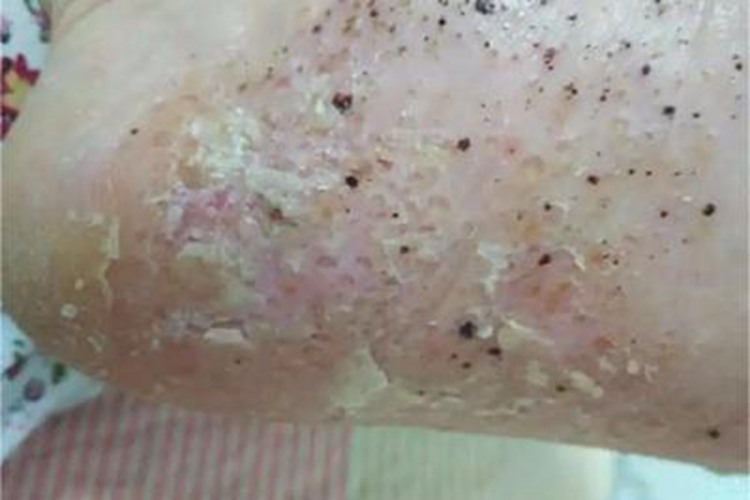 角层下脓疱病皲裂图