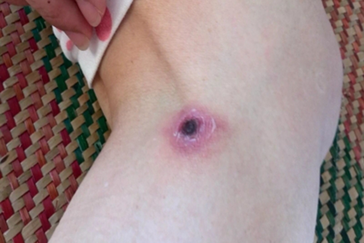 恙虫病小腿红肿图