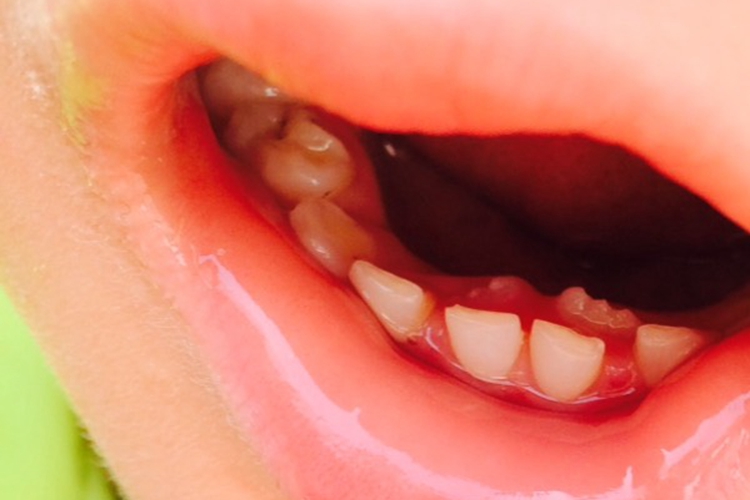 乳牙滞留:小孩牙齿长里面可表现为舌侧,颊侧萌出新牙,若乳牙还未脱落