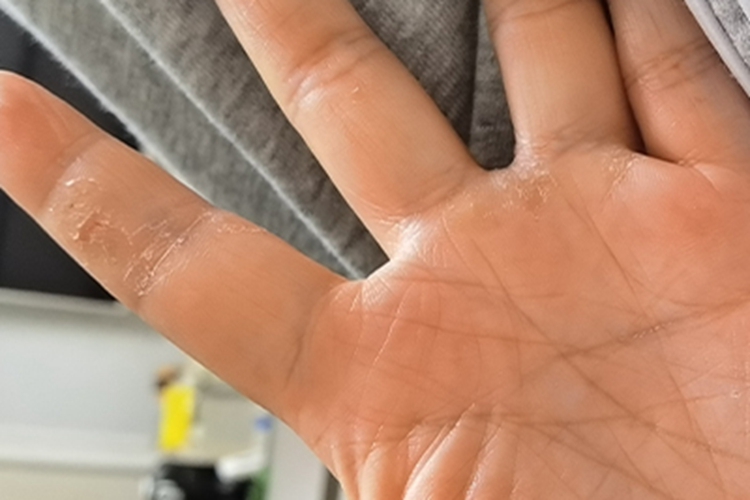 慢性湿疹手指有轻微脱皮图